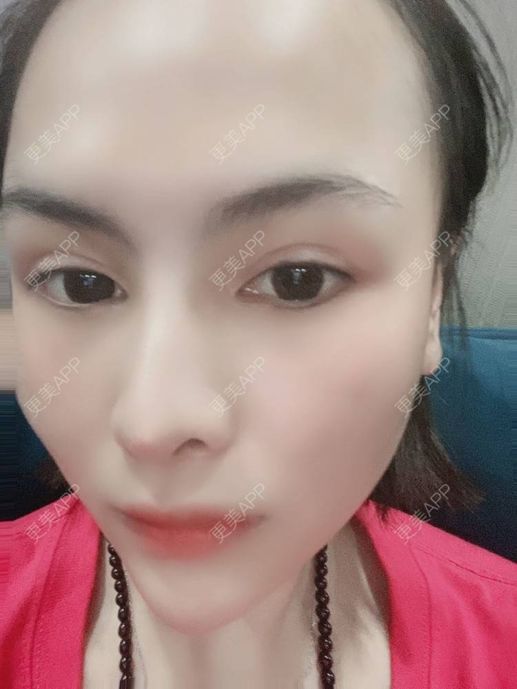 更美 - 怪品味夜的眼部修复经验 | 眼部修复 | 北京 | 双眼皮修复 | 开眼角修复