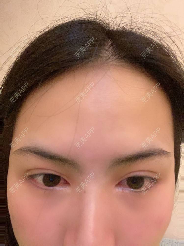 更美 - 怪品味夜的眼部修复经验 | 眼部修复 | 北京 | 双眼皮修复 | 开眼角修复