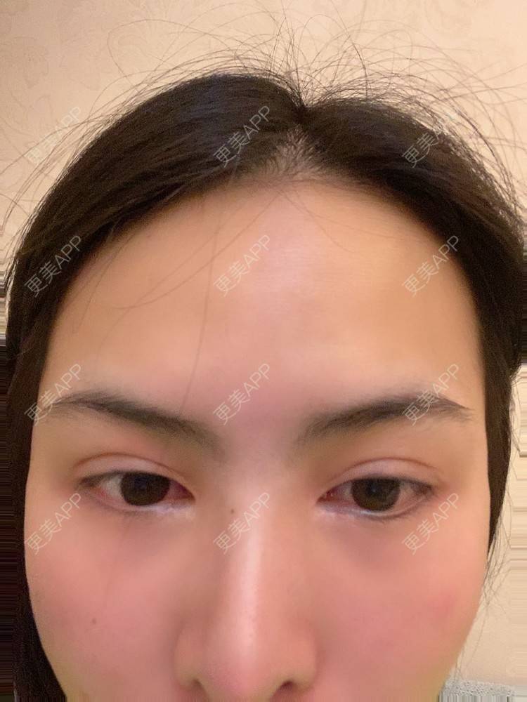更美 - 怪品味夜的眼部修复经验 | 眼部修复 | 北京 | 双眼皮修复 | 开眼角修复