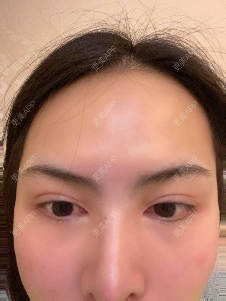 更美 - 怪品味夜的眼部修复经验 | 眼部修复 | 北京 | 双眼皮修复 | 开眼角修复