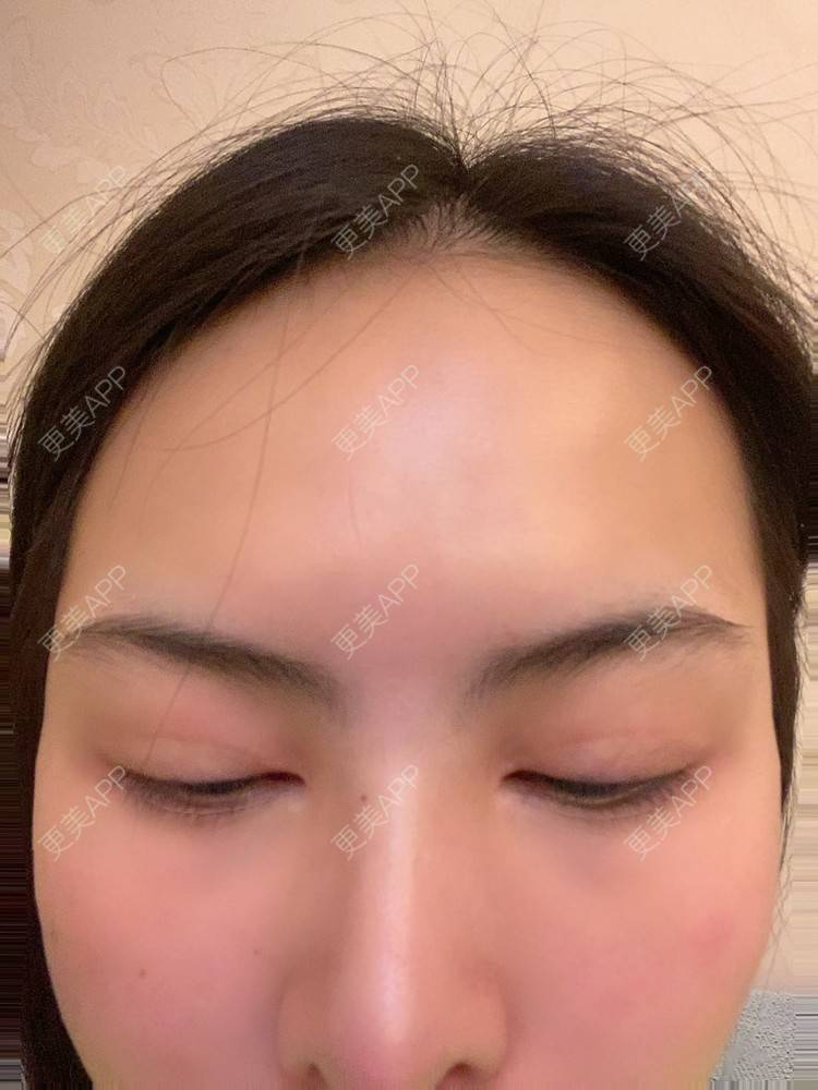 更美 - 怪品味夜的眼部修复经验 | 眼部修复 | 北京 | 双眼皮修复 | 开眼角修复