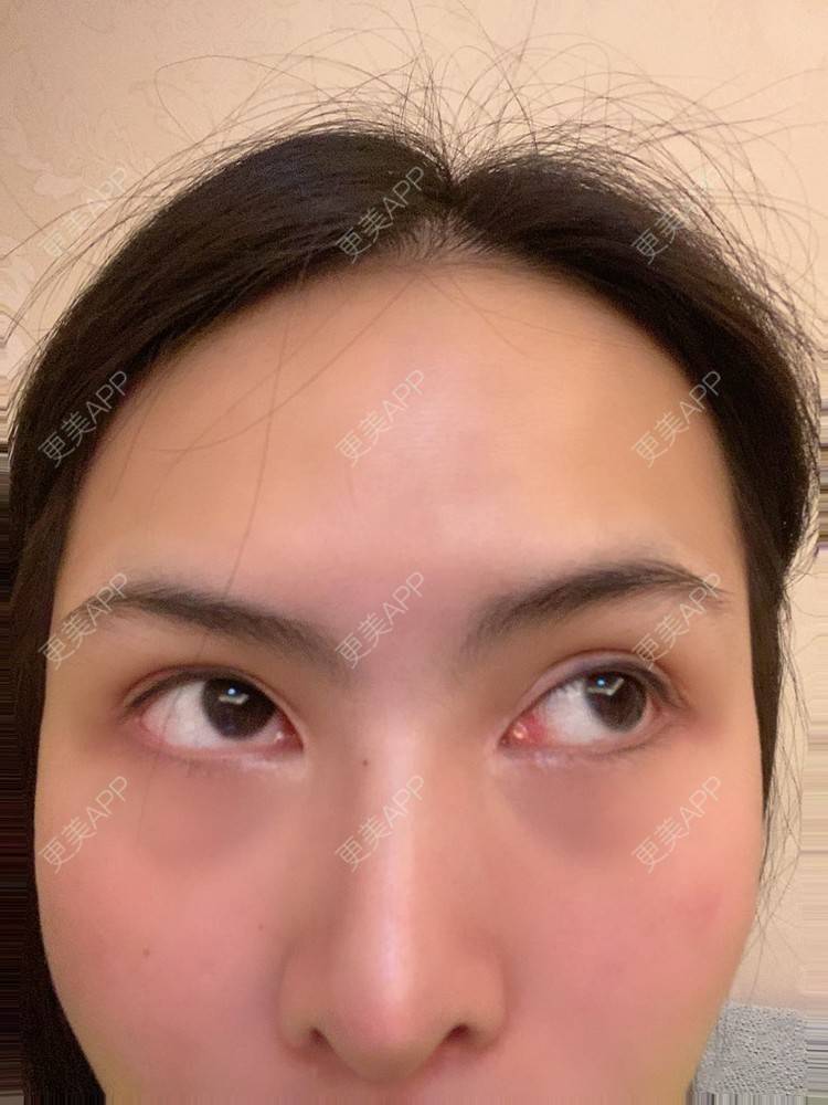 更美 - 怪品味夜的眼部修复经验 | 眼部修复 | 北京 | 双眼皮修复 | 开眼角修复
