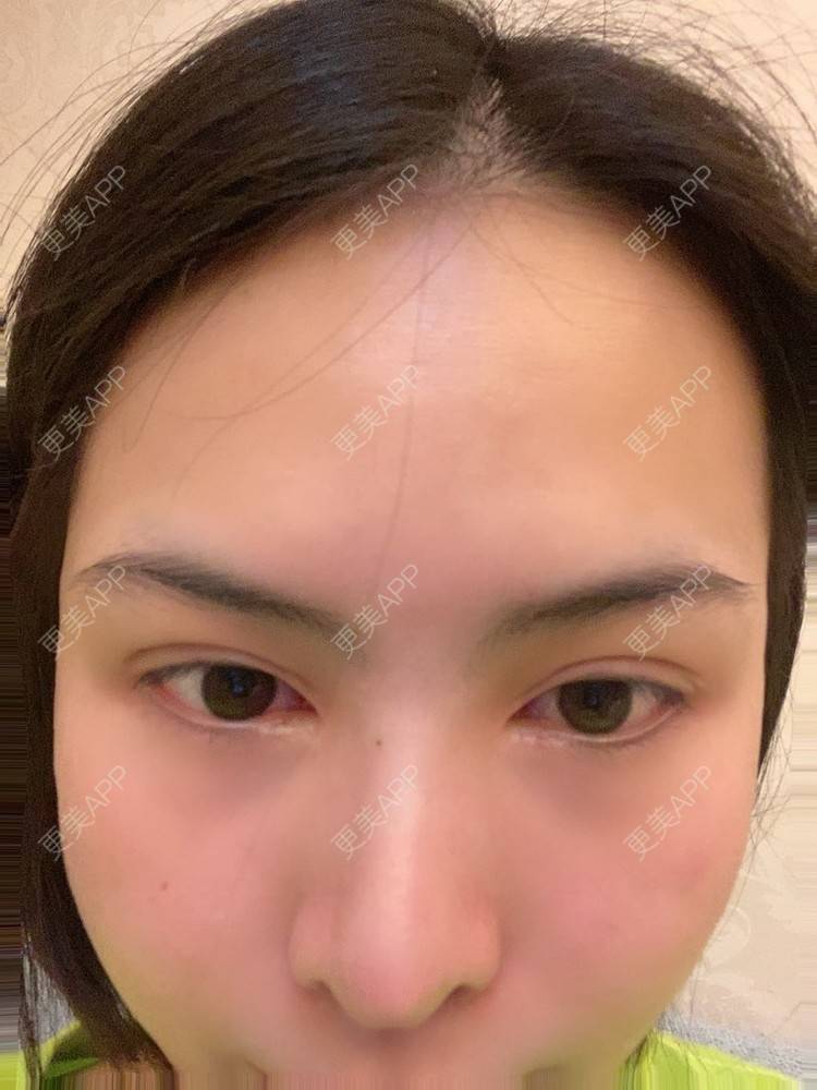 更美 - 怪品味夜的眼部修复经验 | 眼部修复 | 北京 | 双眼皮修复 | 开眼角修复