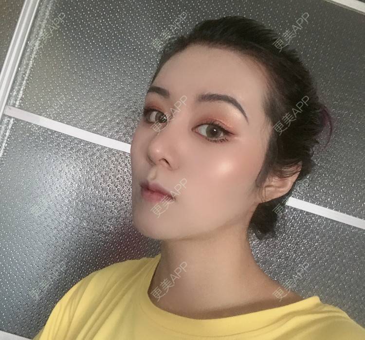 更美 - 更美用户lMuLEZ2cJC的玻尿酸法令纹经验 | 玻尿酸法令纹