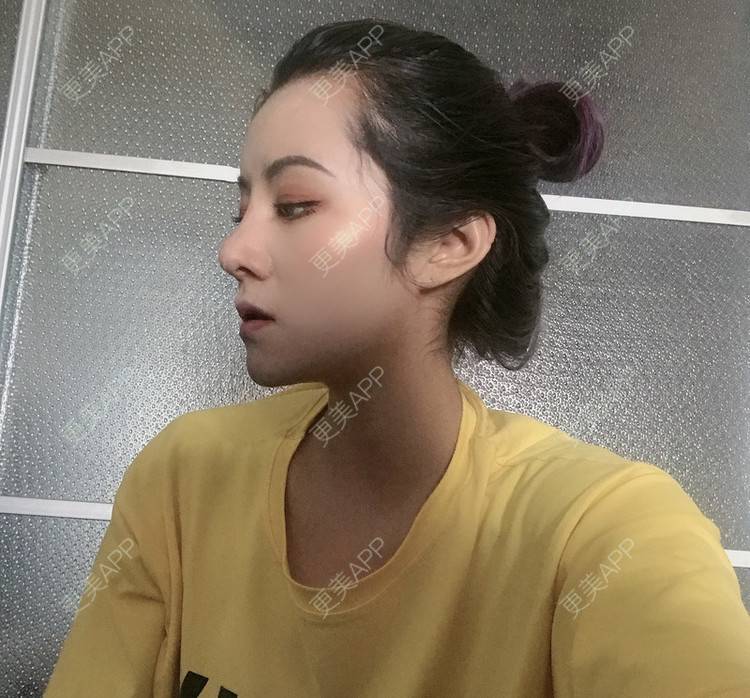 更美 - 更美用户lMuLEZ2cJC的玻尿酸法令纹经验 | 玻尿酸法令纹