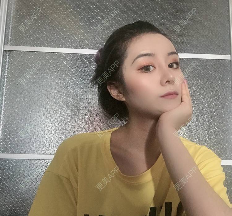 更美 - 更美用户lMuLEZ2cJC的玻尿酸法令纹经验 | 玻尿酸法令纹
