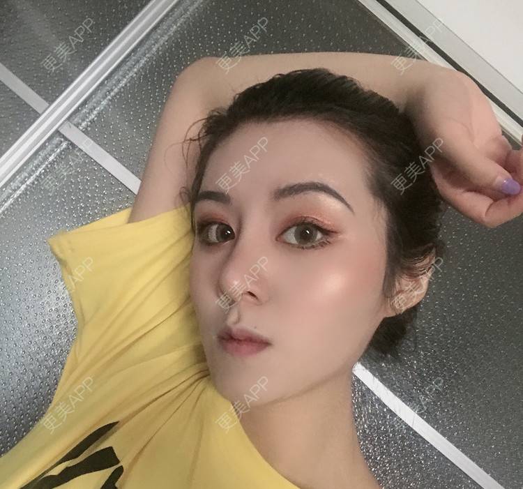 更美 - 更美用户lMuLEZ2cJC的玻尿酸法令纹经验 | 玻尿酸法令纹