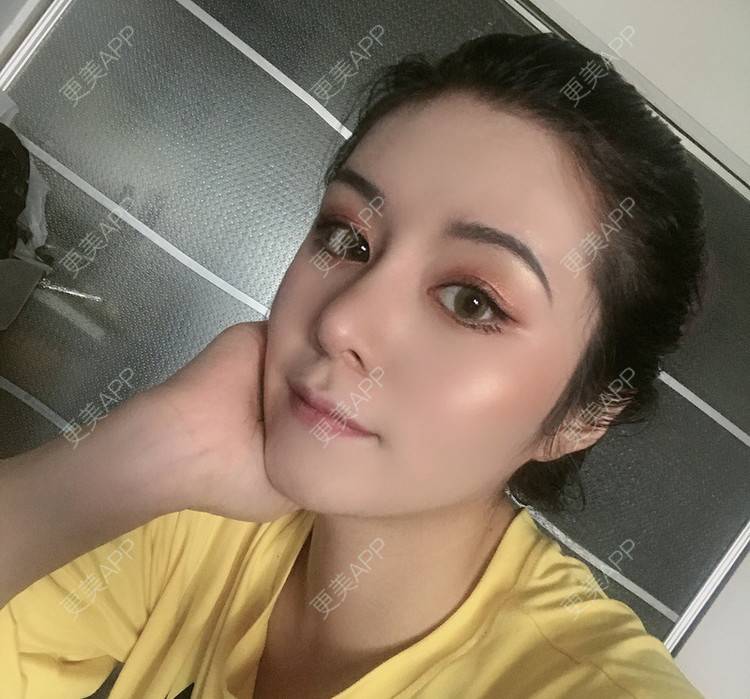 更美 - 更美用户lMuLEZ2cJC的玻尿酸法令纹经验 | 玻尿酸法令纹