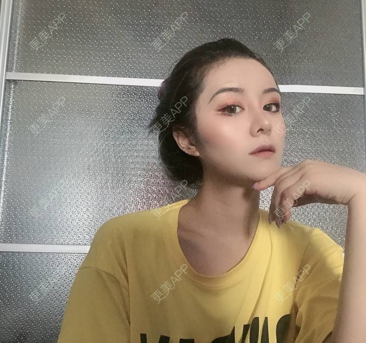 更美 - 更美用户lMuLEZ2cJC的玻尿酸法令纹经验 | 玻尿酸法令纹