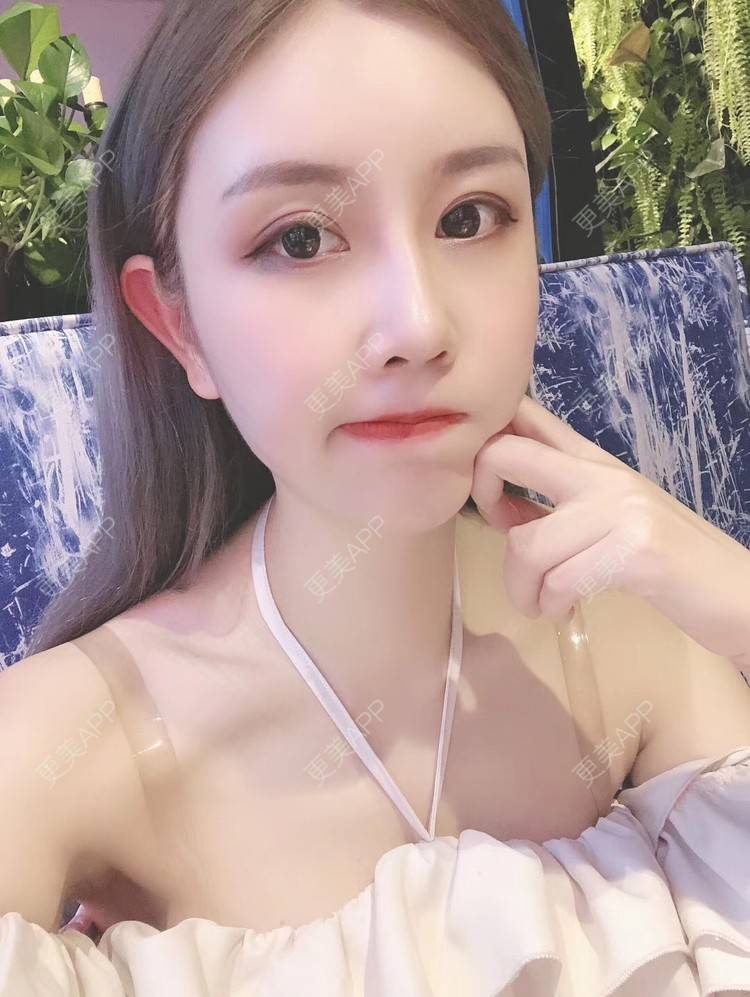 更美 - 邮寄所有的鼻部多项经验 | 鼻部多项 | 膨体隆鼻 | 肋软骨隆鼻 | 鼻中隔软骨隆鼻 | 耳软骨隆鼻 | 泉州