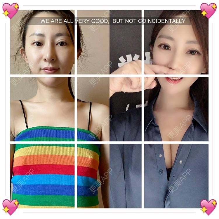 冰雪聪明djh的假体隆胸日记