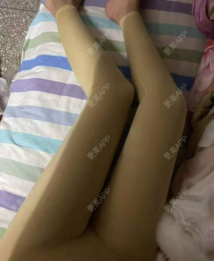 更美 - 更美用户279EaVjOjL的吸脂瘦大腿经验 | 吸脂瘦大腿 | 小腿吸脂