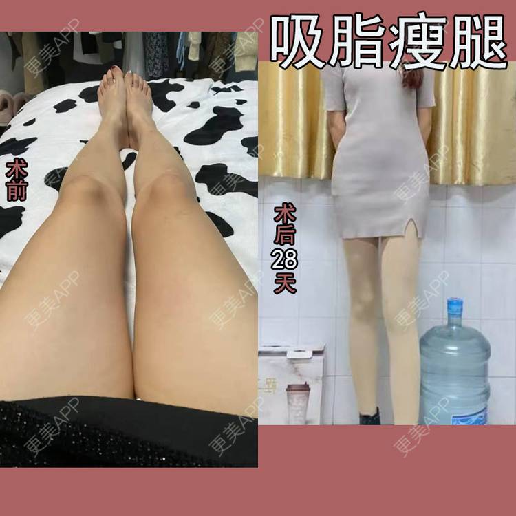 更美 - 更美用户279EaVjOjL的吸脂瘦大腿经验 | 吸脂瘦大腿 | 小腿吸脂