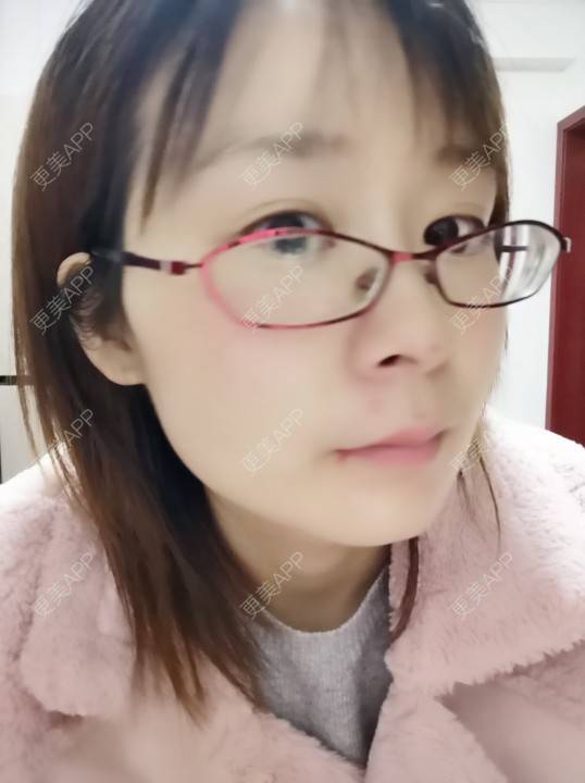 更美 - 更美用户srpv6JiXYY的玻尿酸苹果肌经验 | 玻尿酸苹果肌 | 上海