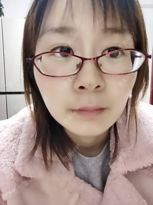 更美 - 更美用户srpv6JiXYY的玻尿酸苹果肌经验 | 玻尿酸苹果肌 | 上海