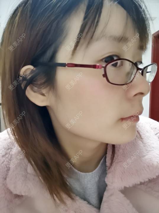 更美 - 更美用户srpv6JiXYY的玻尿酸苹果肌经验 | 玻尿酸苹果肌 | 上海