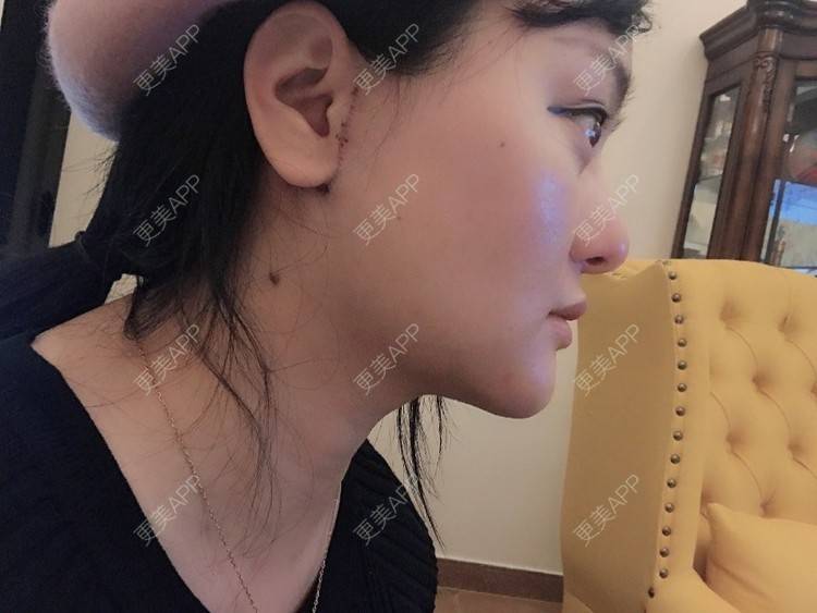 更美 - 三生有幸呀的硅胶垫下巴经验 | 硅胶垫下巴 | 膨体垫下巴 | 宽下巴矫正 | 下巴硅胶假体取出 | 下巴膨体假体取出