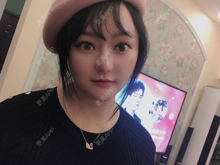 更美 - 三生有幸呀的硅胶垫下巴经验 | 硅胶垫下巴 | 膨体垫下巴 | 宽下巴矫正 | 下巴硅胶假体取出 | 下巴膨体假体取出