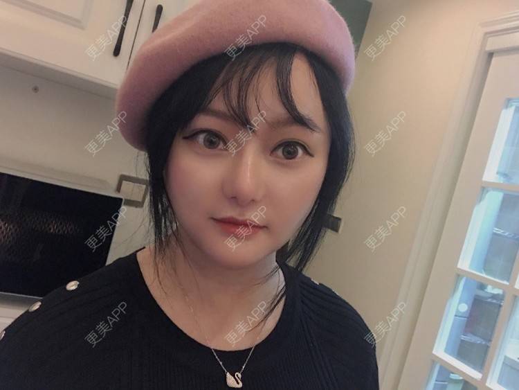更美 - 三生有幸呀的硅胶垫下巴经验 | 硅胶垫下巴 | 膨体垫下巴 | 宽下巴矫正 | 下巴硅胶假体取出 | 下巴膨体假体取出