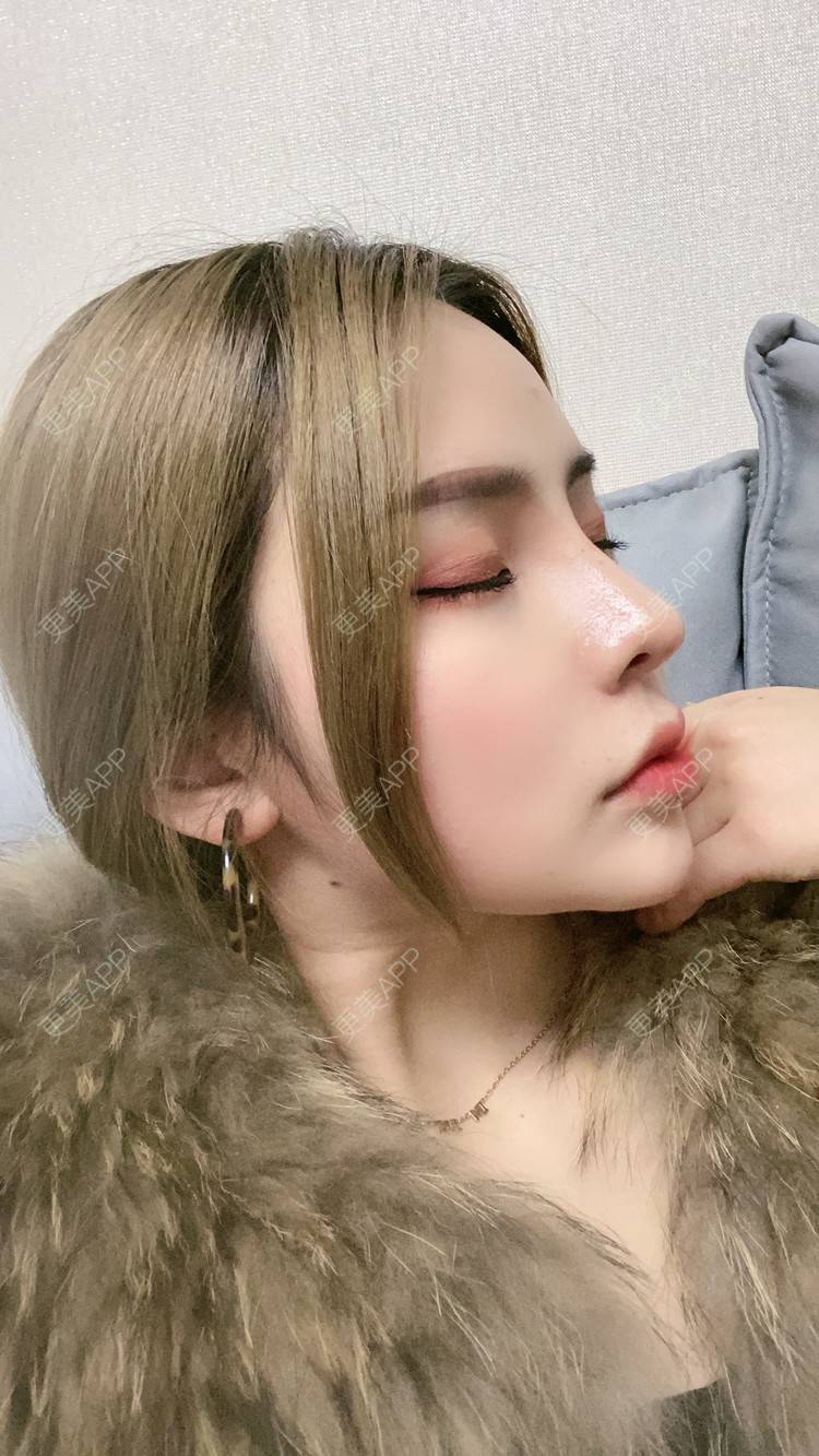 更美 - 大CC阿姨的肋软骨隆鼻经验 | 成都 | 肋软骨隆鼻 | 视频日记