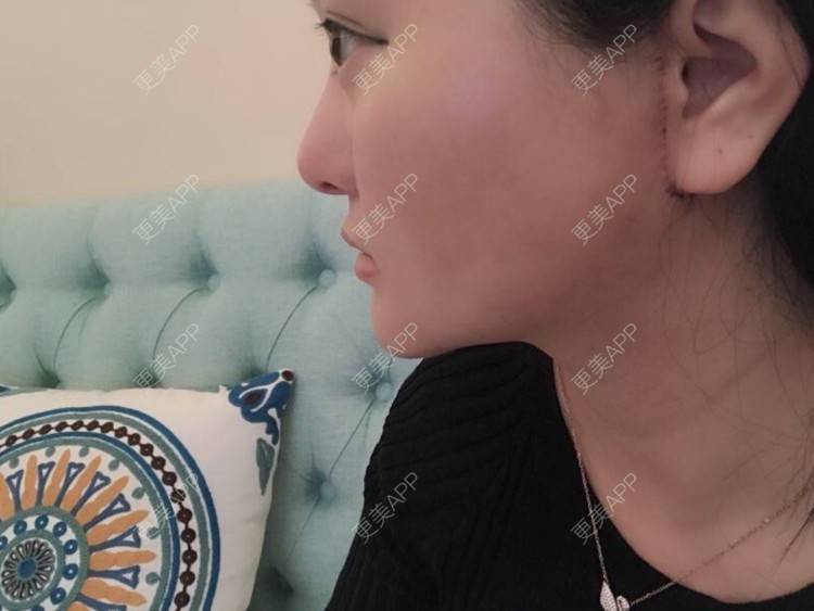 更美 - 三生有幸呀的硅胶垫下巴经验 | 硅胶垫下巴 | 膨体垫下巴 | 宽下巴矫正 | 下巴硅胶假体取出 | 下巴膨体假体取出