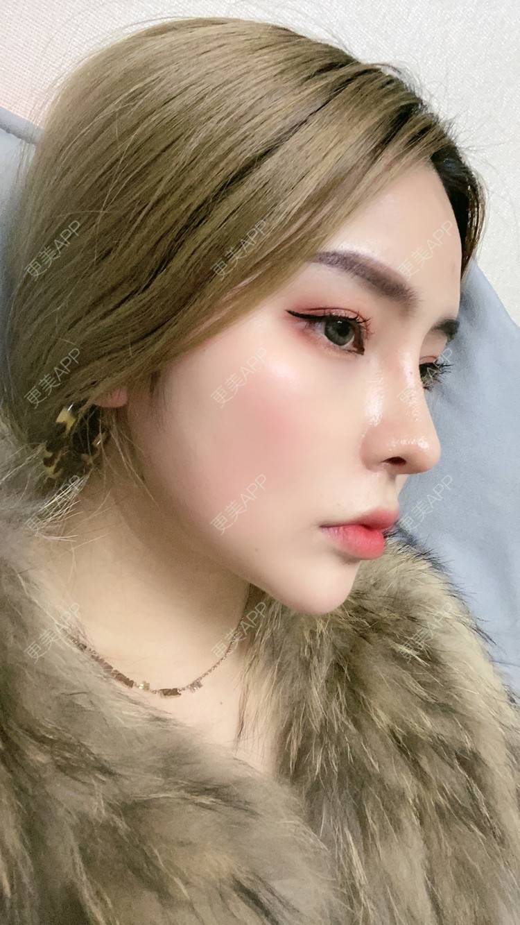 更美 - 大CC阿姨的肋软骨隆鼻经验 | 成都 | 肋软骨隆鼻 | 视频日记