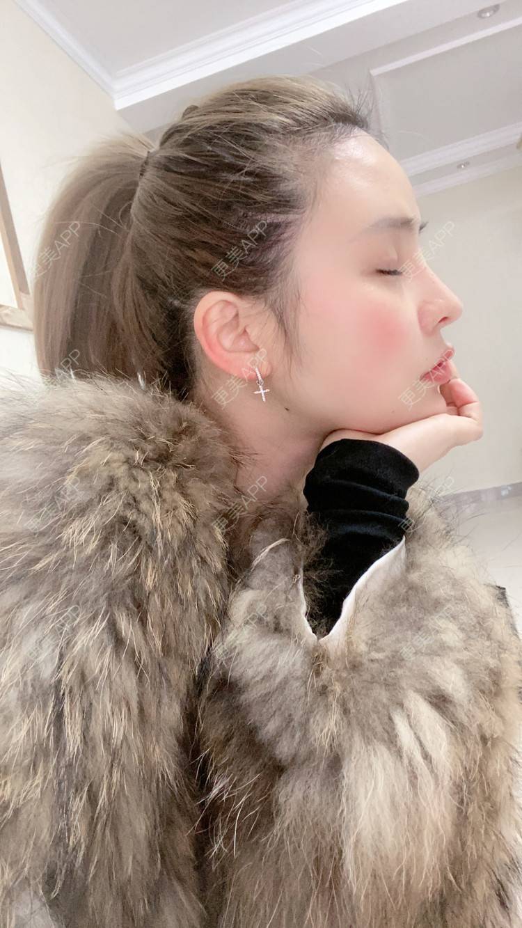 更美 - 大CC阿姨的肋软骨隆鼻经验 | 成都 | 肋软骨隆鼻 | 视频日记