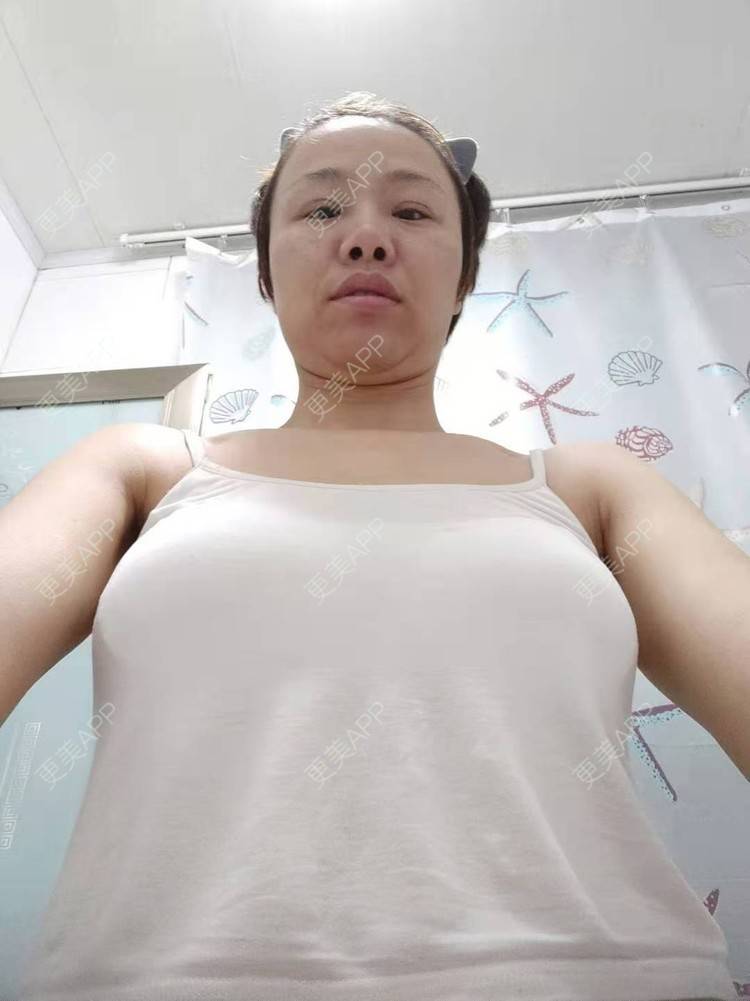 更美 - 更美用户gZFN64zuwo的丰胸（隆胸）经验 | 丰胸（隆胸） | 复合隆胸 | 假体隆胸 | 乳房再造 | 乳头内陷矫正 | 胸部下垂矫正 | 自体脂肪隆胸 | 重庆 | 胶原蛋白丰胸 | 美胸套餐