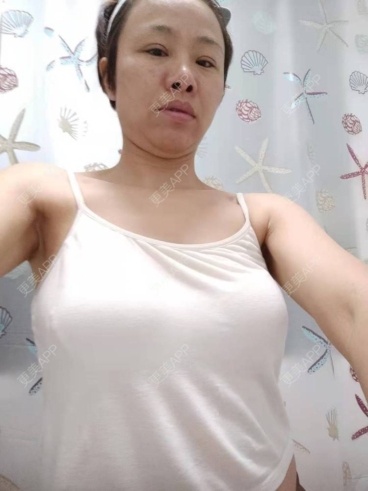 更美 - 更美用户gZFN64zuwo的丰胸（隆胸）经验 | 丰胸（隆胸） | 复合隆胸 | 假体隆胸 | 乳房再造 | 乳头内陷矫正 | 胸部下垂矫正 | 自体脂肪隆胸 | 重庆 | 胶原蛋白丰胸 | 美胸套餐