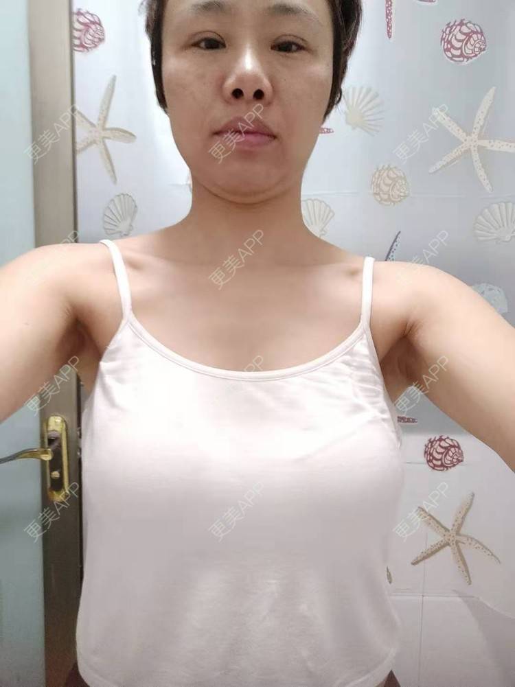 更美 - 更美用户gZFN64zuwo的丰胸（隆胸）经验 | 丰胸（隆胸） | 复合隆胸 | 假体隆胸 | 乳房再造 | 乳头内陷矫正 | 胸部下垂矫正 | 自体脂肪隆胸 | 重庆 | 胶原蛋白丰胸 | 美胸套餐