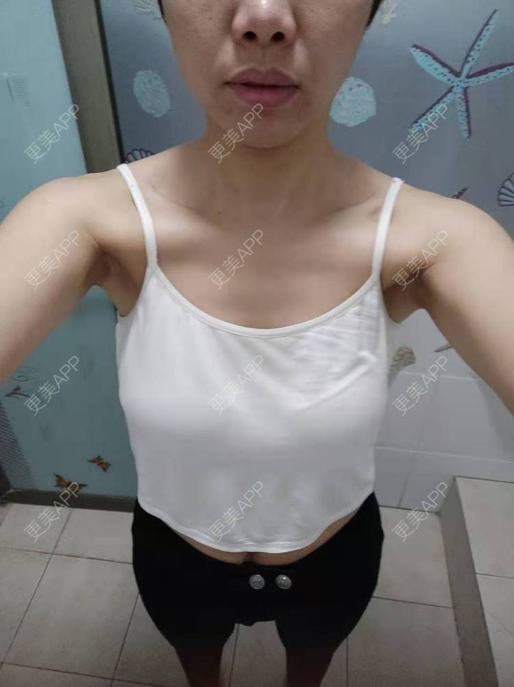 更美 - 更美用户gZFN64zuwo的丰胸（隆胸）经验 | 丰胸（隆胸） | 复合隆胸 | 假体隆胸 | 乳房再造 | 乳头内陷矫正 | 胸部下垂矫正 | 自体脂肪隆胸 | 重庆 | 胶原蛋白丰胸 | 美胸套餐