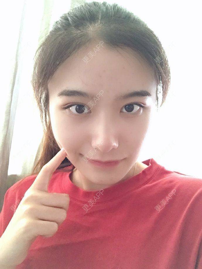 更美 - 更美用户5UwFBwZBdz的鼻部多项经验 | 鼻部多项 | 长沙