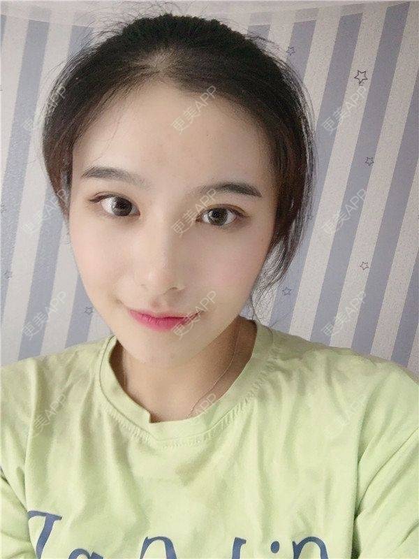 更美 - 更美用户5UwFBwZBdz的鼻部多项经验 | 鼻部多项 | 长沙