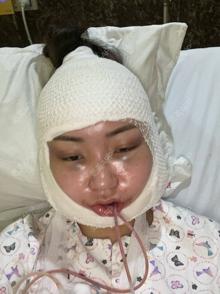 更美用户wdum4uzhx7的下颌角切除术日记