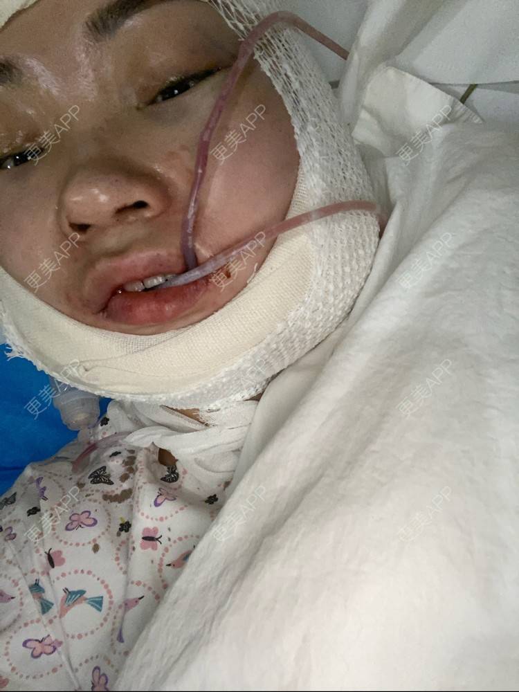 更美用户wdum4uzhx7的下颌角切除术日记