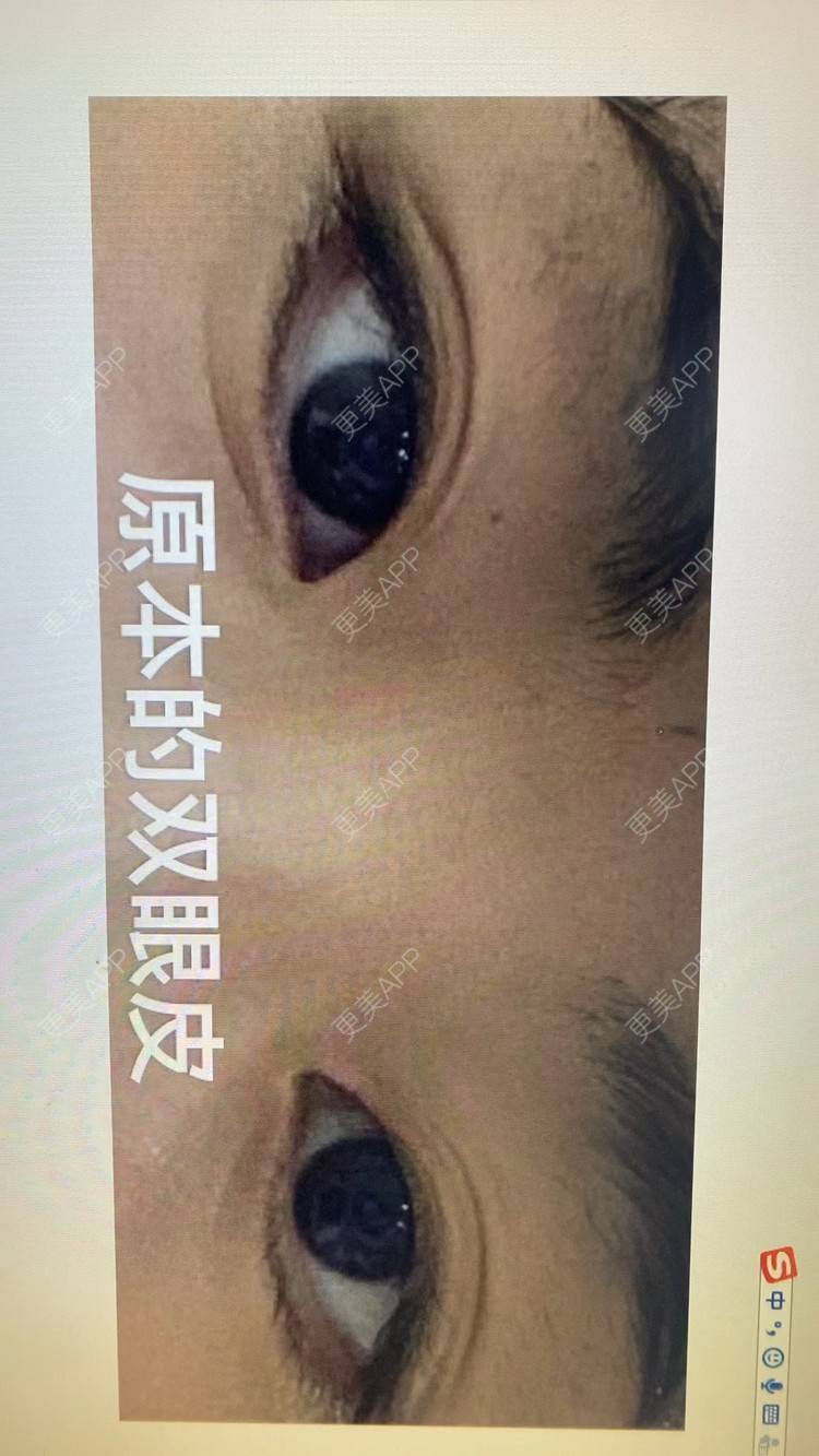 更美 - if you if的开内眼角经验 | 上海 | 眼部多项