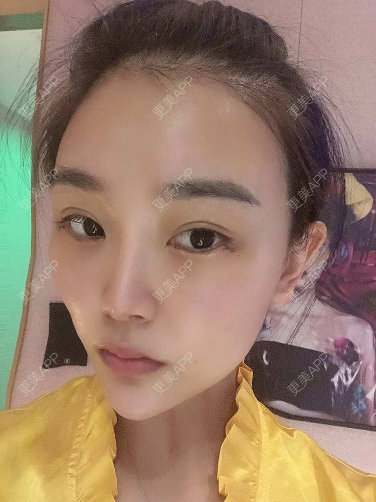 更美 - 更美用户wOARiRO1Ls的真皮丰卧蚕经验 | 北京 | 真皮丰卧蚕