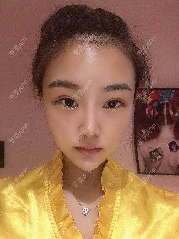 更美 - 更美用户wOARiRO1Ls的真皮丰卧蚕经验 | 北京 | 真皮丰卧蚕