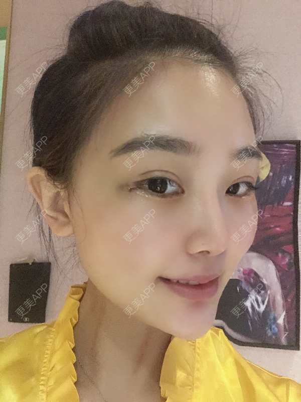 更美 - 更美用户wOARiRO1Ls的真皮丰卧蚕经验 | 北京 | 真皮丰卧蚕