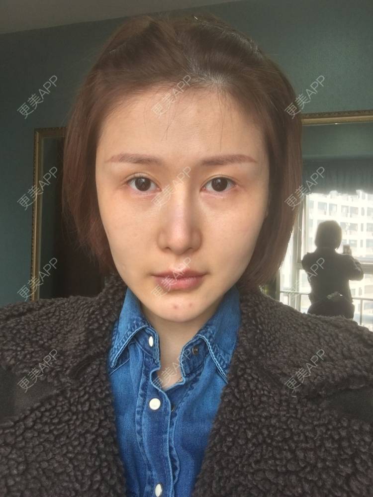 更美 - 月妹儿1027的自体脂肪丰苹果肌经验 | 自体脂肪全面部填充 | 视频日记 | 自体脂肪丰面颊 | 自体脂肪丰太阳穴 | 埋线提升 | 重庆 | 自体脂肪丰额头 | 自体脂肪丰苹果肌