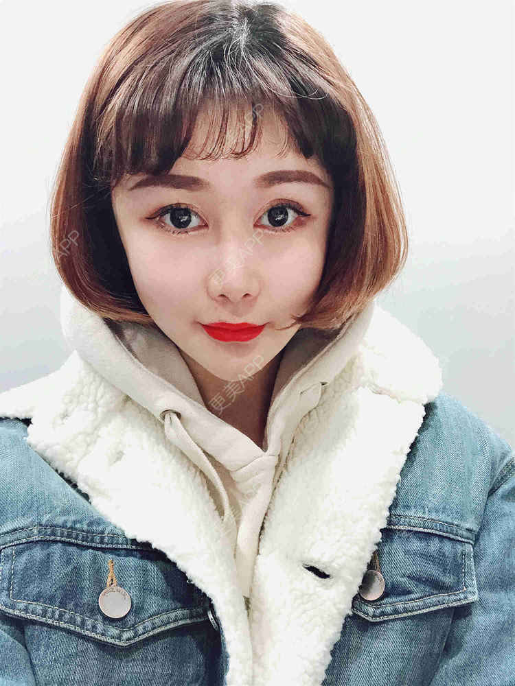 更美 - 月妹儿1027的自体脂肪丰苹果肌经验 | 自体脂肪全面部填充 | 视频日记 | 自体脂肪丰面颊 | 自体脂肪丰太阳穴 | 埋线提升 | 重庆 | 自体脂肪丰额头 | 自体脂肪丰苹果肌