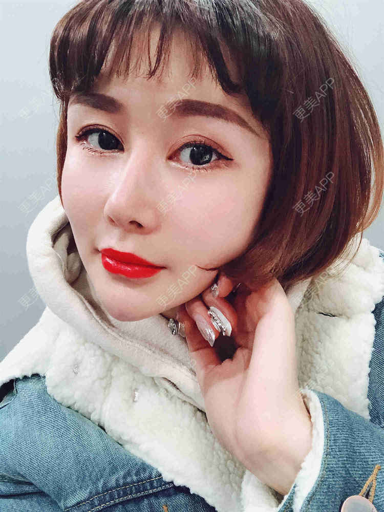 更美 - 月妹儿1027的自体脂肪丰苹果肌经验 | 自体脂肪全面部填充 | 视频日记 | 自体脂肪丰面颊 | 自体脂肪丰太阳穴 | 埋线提升 | 重庆 | 自体脂肪丰额头 | 自体脂肪丰苹果肌
