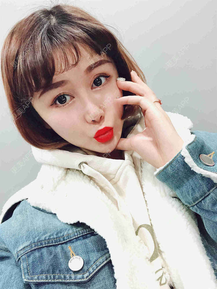 更美 - 月妹儿1027的自体脂肪丰苹果肌经验 | 自体脂肪全面部填充 | 视频日记 | 自体脂肪丰面颊 | 自体脂肪丰太阳穴 | 埋线提升 | 重庆 | 自体脂肪丰额头 | 自体脂肪丰苹果肌