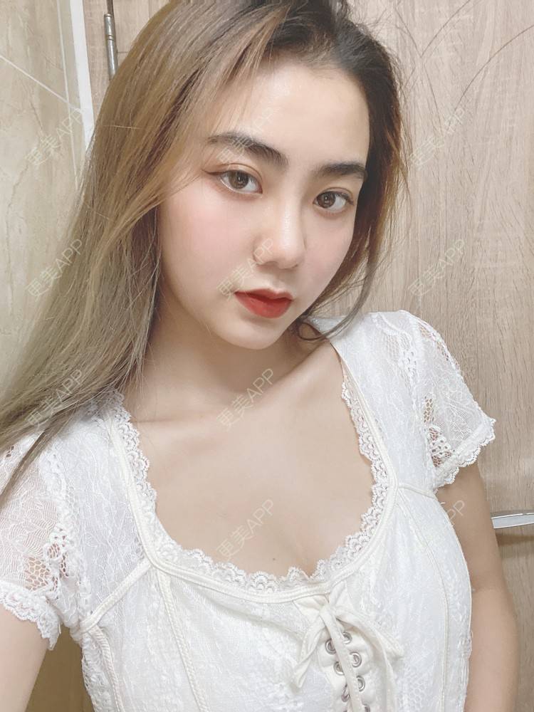更美 - 更美用户IyTX4zwALn的隆胸手术修复经验 | 假体隆胸 | 隆胸手术修复 | 美胸套餐 | 手术去副乳 | 乳头内陷矫正 | 苏州