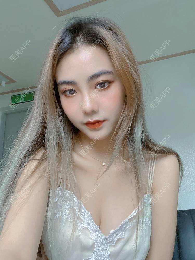 更美 - 更美用户IyTX4zwALn的隆胸手术修复经验 | 假体隆胸 | 隆胸手术修复 | 美胸套餐 | 手术去副乳 | 乳头内陷矫正 | 苏州