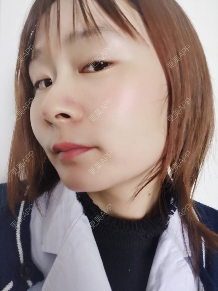 更美 - 更美用户srpv6JiXYY的玻尿酸苹果肌经验 | 玻尿酸苹果肌 | 上海