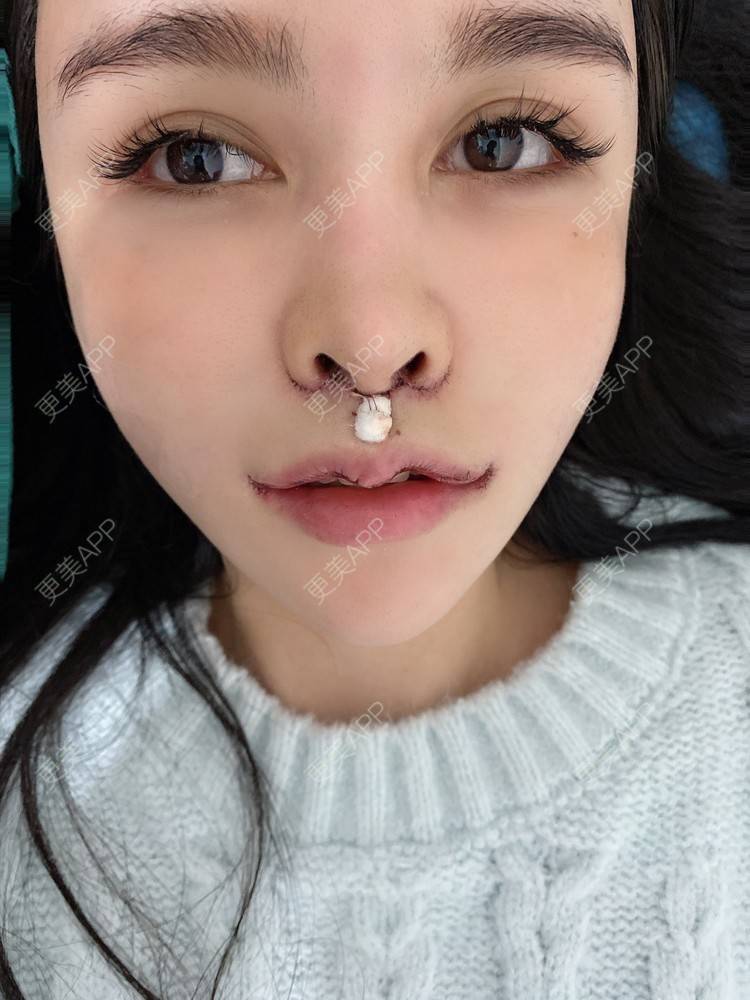 更美用户suxbnfsndt的m唇成形术日记