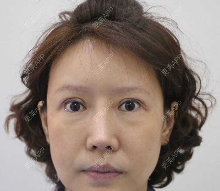 更美 - ⒈心只为你恳的综合去眼袋经验 | 眶隔脂肪释放 | 内切去眼袋 | 外切去眼袋 | 综合去眼袋 | 北京