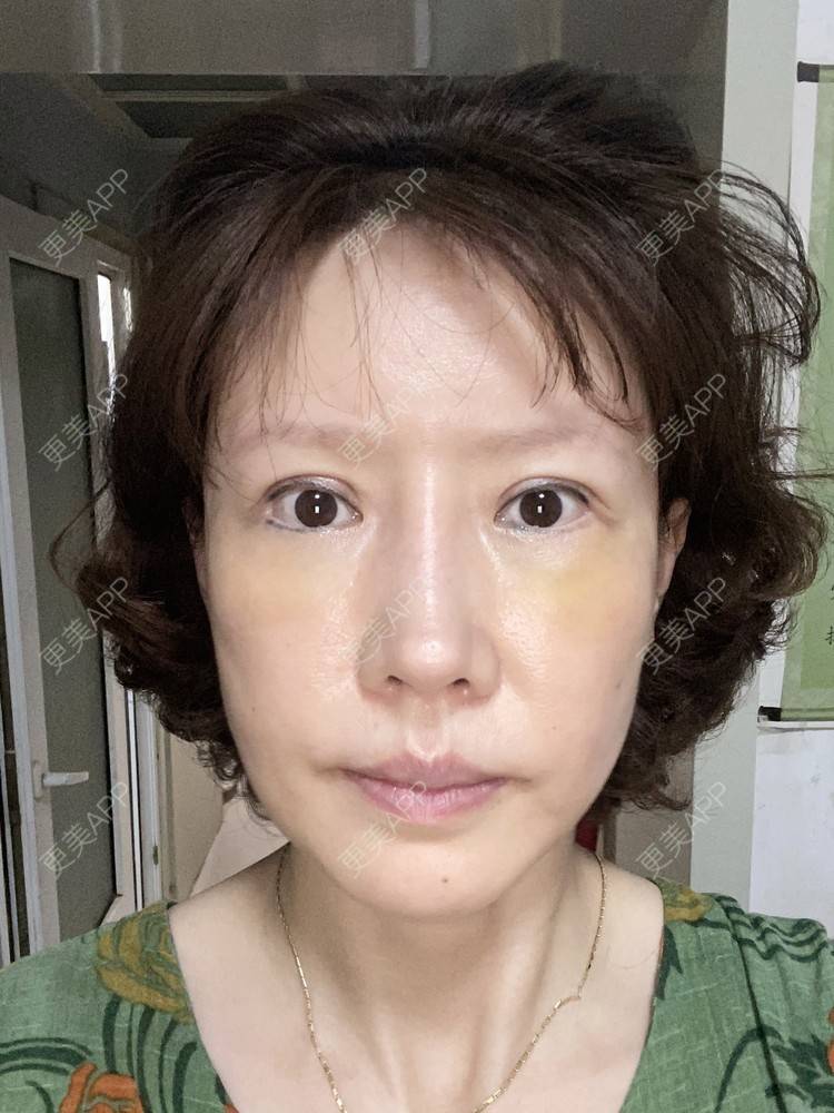 更美 - ⒈心只为你恳的综合去眼袋经验 | 眶隔脂肪释放 | 内切去眼袋 | 外切去眼袋 | 综合去眼袋 | 北京