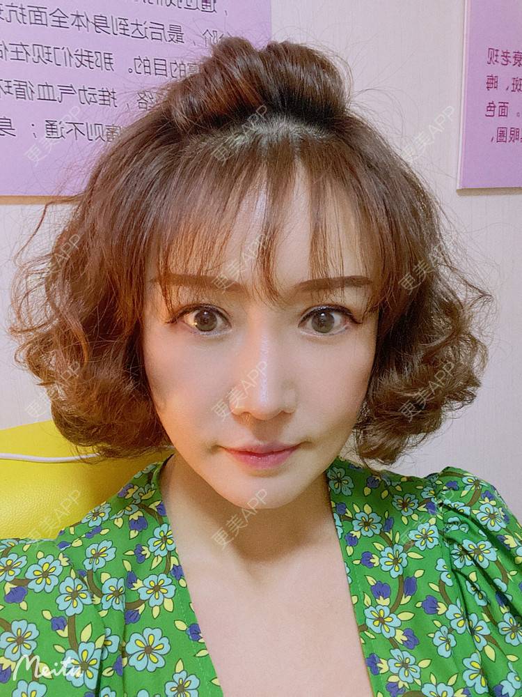 更美 - ⒈心只为你恳的综合去眼袋经验 | 眶隔脂肪释放 | 内切去眼袋 | 外切去眼袋 | 综合去眼袋 | 北京